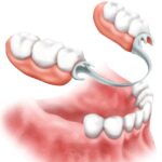 Зубные протезы - преимущества бюгельного протезирования