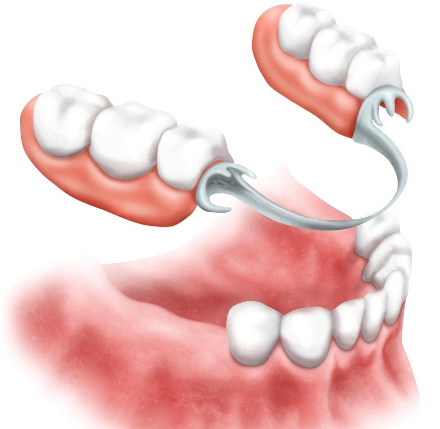Зубные протезы — преимущества бюгельного протезирования