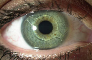 Заміна кришталика ока: Коли приходить час до штучного втручання