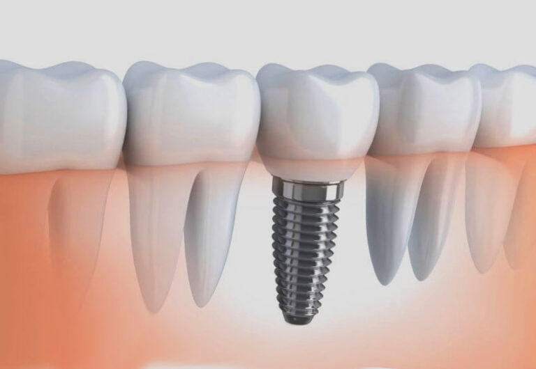 Зубні імплантати: Революція в стоматології