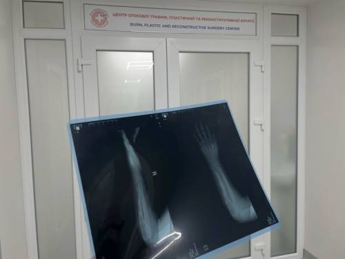 Підступна хвороба. У Львові дитині відновили 4 см кістки, знищеної&hellip;